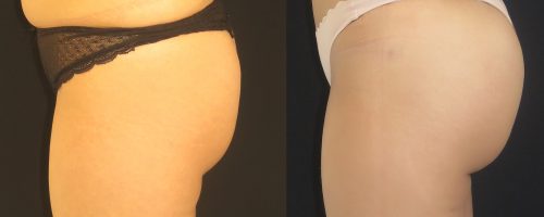 Lipofilling de fesses