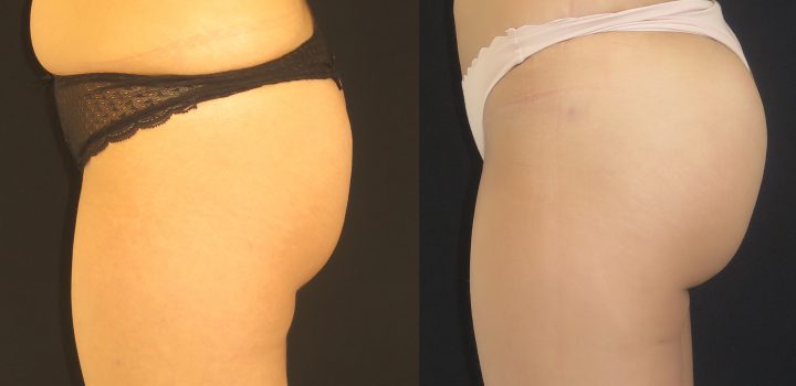 Lipofilling de fesses