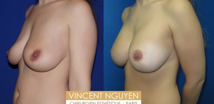 Lifting des seins avec prothèse et cicatrice en T (résultat à 1 an)