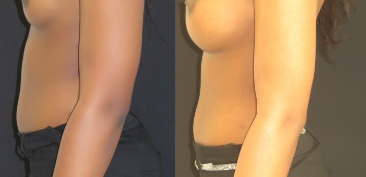 Augmentation mammaire par prothèse anatomique en dual plan par voie sous-mammaire