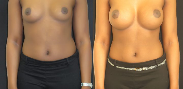 Augmentation mammaire par prothèse anatomique en dual plan par voie sous-mammaire