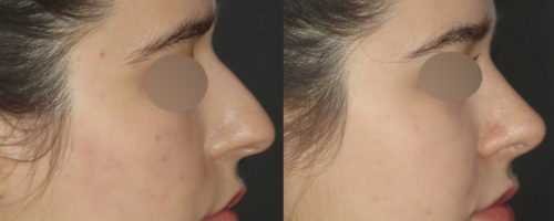 Rhinoplastie Paris - Prix chirurgie esthétique et réparatrice du nez