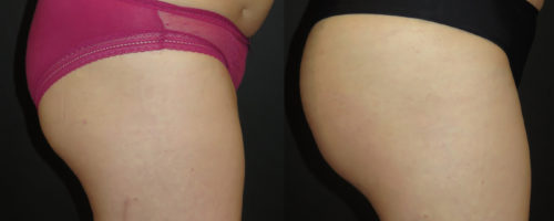 lipofilling de fesses