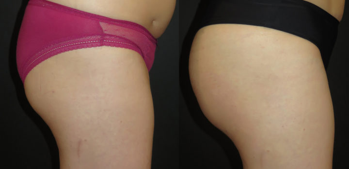 lipofilling de fesses