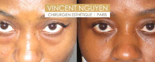 blépharoplastie inférieure