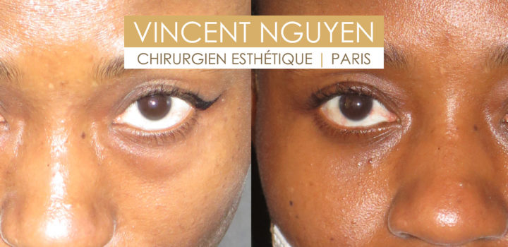 blépharoplastie inférieure