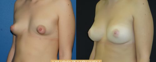 augmentation mammaire par prohèses pour seins tubéreux