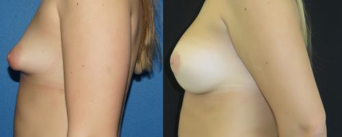 augmentation mammaire par prohèses pour seins tubéreux