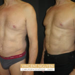 Lipoaspiration avec abdominal etching