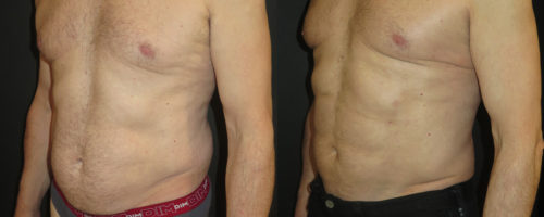 Lipoaspiration avec abdominal etching