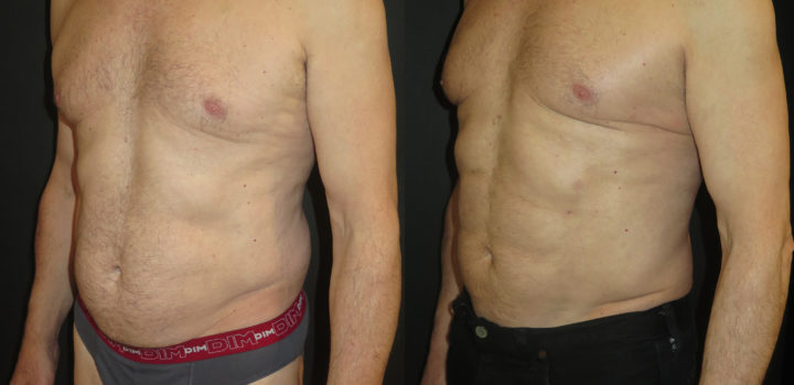 Lipoaspiration avec abdominal etching