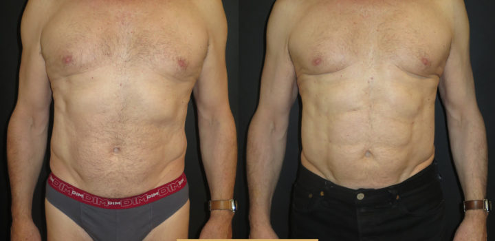 Lipoaspiration avec abdominal etching