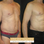 Lipoaspiration avec abdominal etching