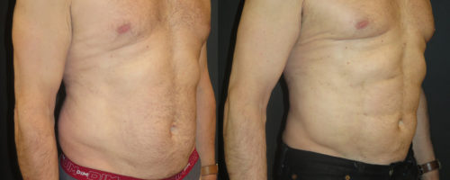 Lipoaspiration avec abdominal etching