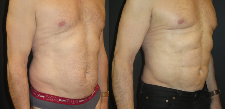 Lipoaspiration avec abdominal etching