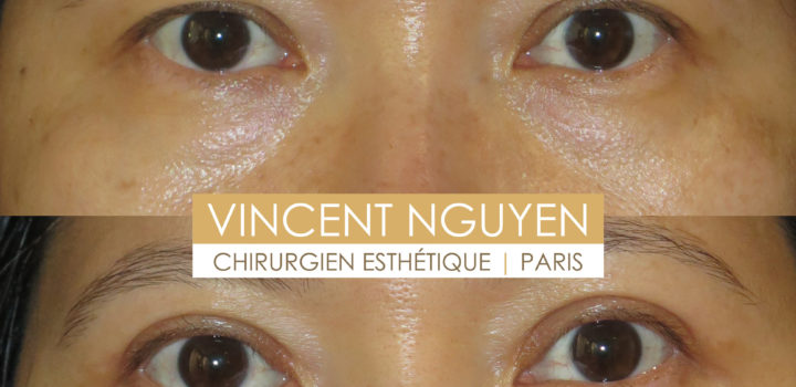 blépharoplastie supérieure et inférieure