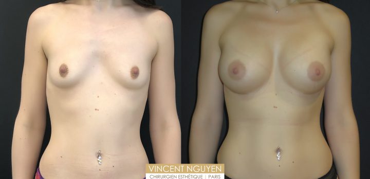 Augmentation mammaire composite
