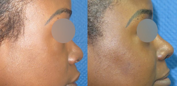 Rhinoplastie avant après