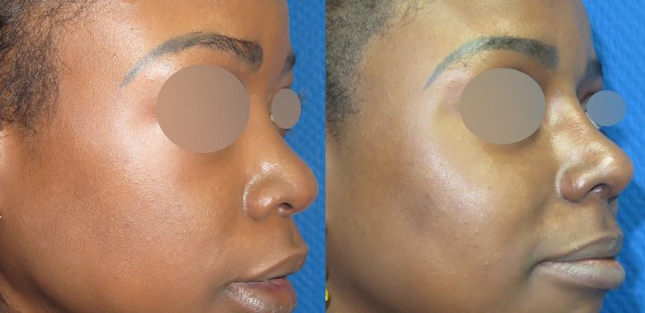 Rhinoplastie d'augmentation