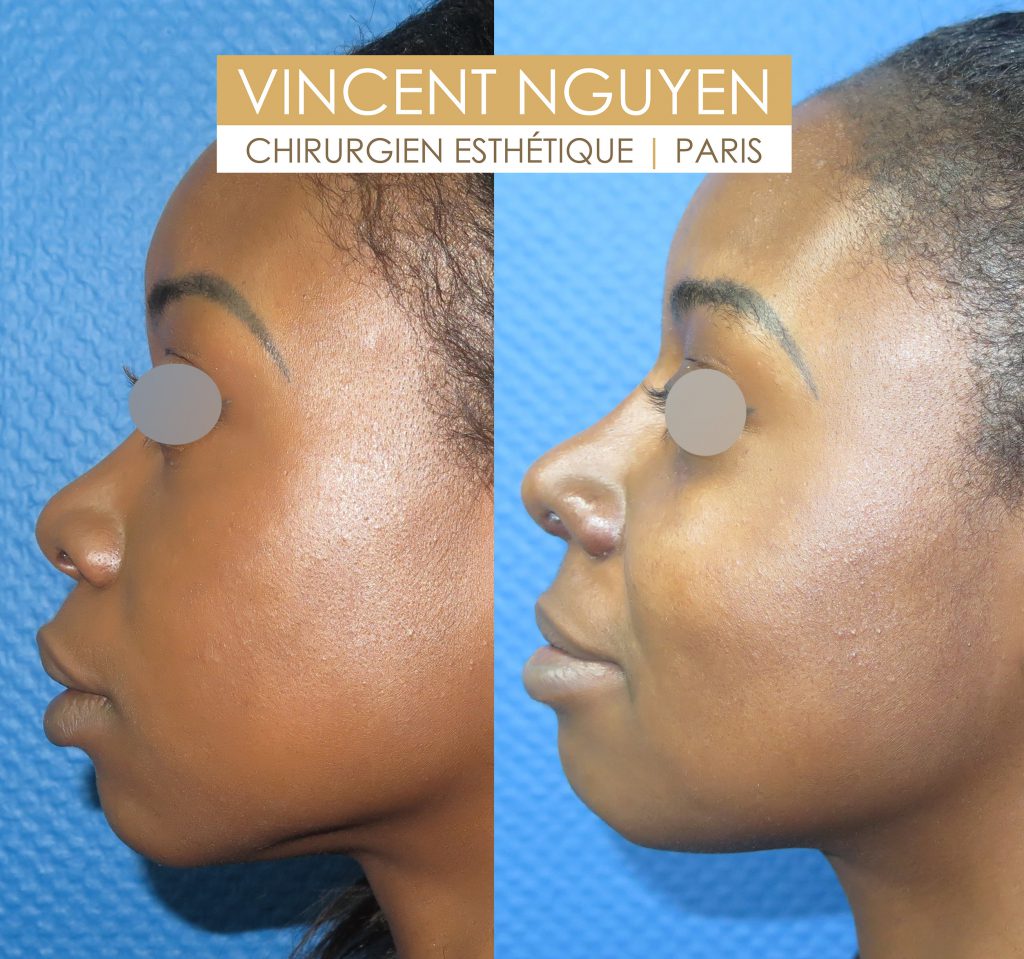 Prix d'une rhinoplastie en france