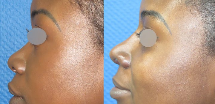 Rhinoplastie avant après