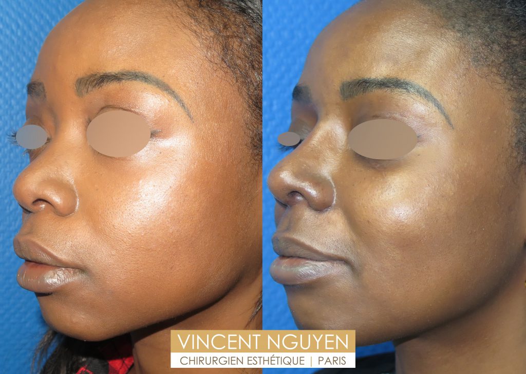 Rhinoplastie Paris - Prix chirurgie esthétique et réparatrice du nez