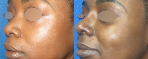 Rhinoplastie d'augmentation