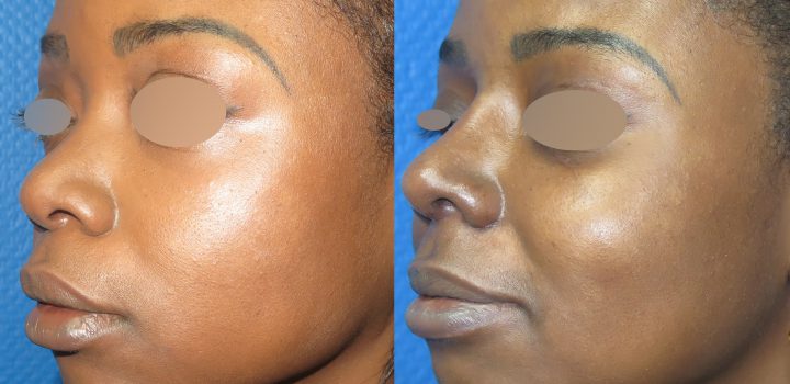 Rhinoplastie d'augmentation