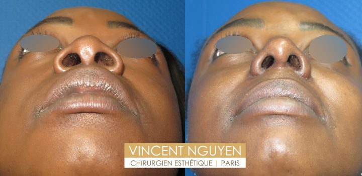 Rhinoplastie avant après