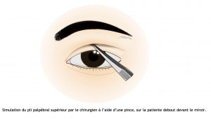 blépharoplastie asiatique