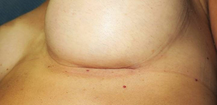 Cicatrice sous-mammaire à 1 mois pour prothèse mammaire (1)