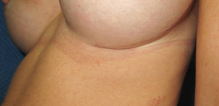 Cicatrice sous-mammaire à 1 mois pour prothèse mammaire (2)