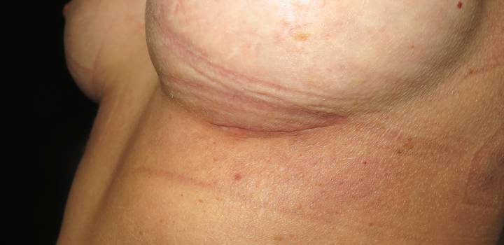 Cicatrice sous-mammaire à 1 mois pour prothèse mammaire (3)