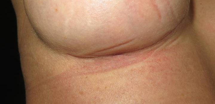 Cicatrice sous-mammaire à 1 mois pour prothèse mammaire (4)