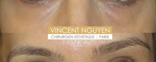 blépharoplastie inférieure