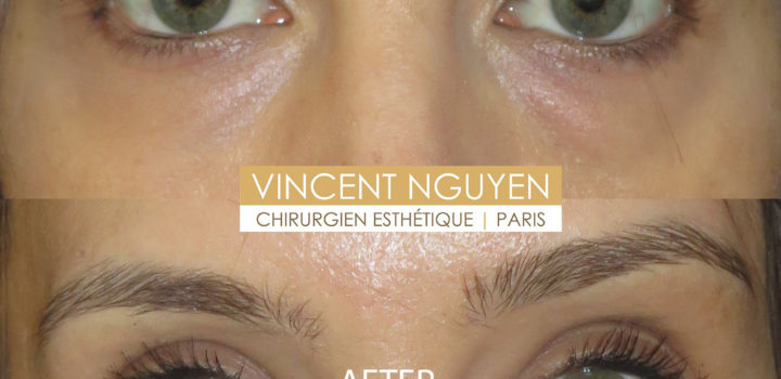 blépharoplastie inférieure