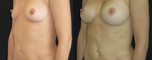 Augmentation mammaire composite