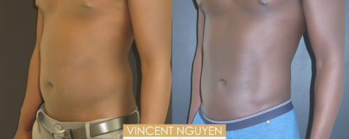 Lipoaspiration abdomen et flancs