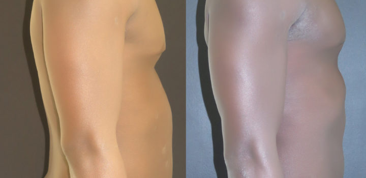 Lipoaspiration abdomen et flancs