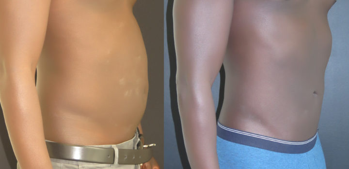 lipoaspiration homme avant après