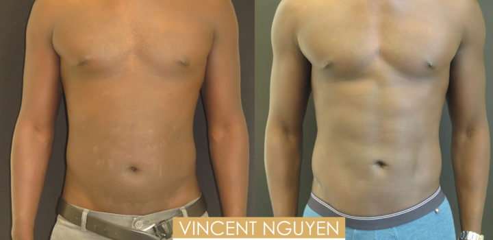 lipoaspiration homme