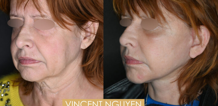 lifting cervico facial