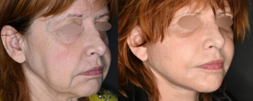 lifting cervico facial