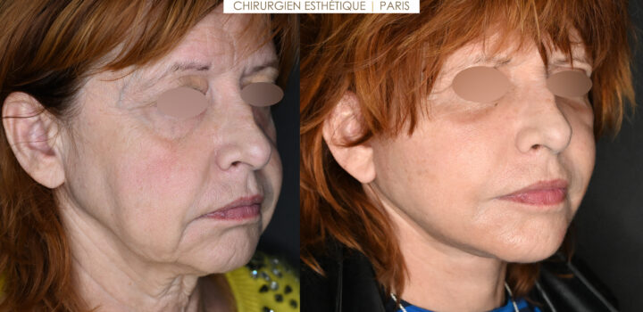 lifting cervico facial