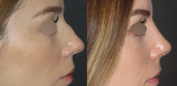 Rhinoplastie