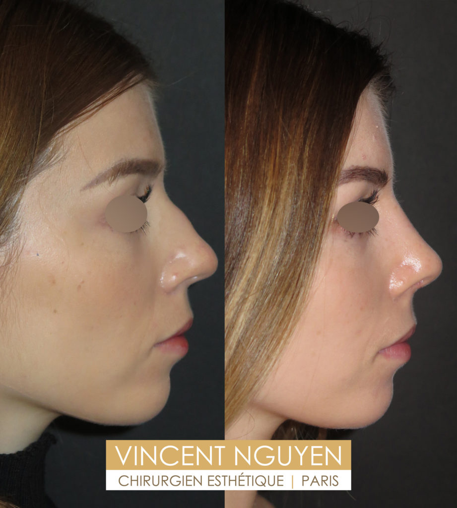 Rhinoplastie Paris - Prix chirurgie esthétique et réparatrice du nez