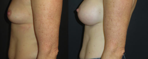augmentation mammaire par prothèse en dual plan