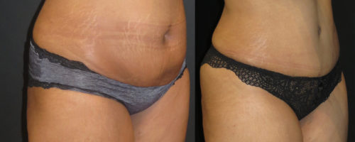 abdominoplastie