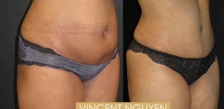 abdominoplastie