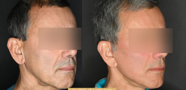 lifting cervico facial